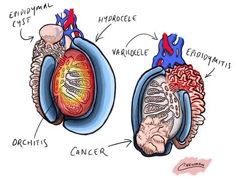 lump on testes hard|lump on both testicles.